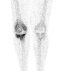 Bone Scan TKR